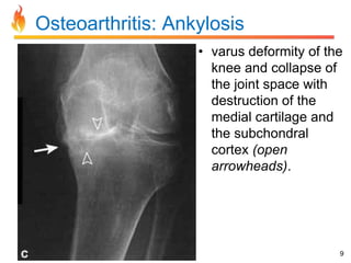 Osteoarthritis: Ankylosis
• varus deformity of the
knee and collapse of
the joint space with
destruction of the
medial cartilage and
the subchondral
cortex (open
arrowheads).

9

 