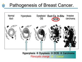 Pathogenesis of Breast Cancer.
Duct Ca. in-Situ
DCIS

Hyperplasia  Dysplasia  DCIS  Carcinoma
Fibrocystic change  Cancer

 