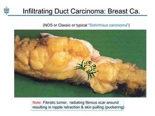 Infiltrating Duct Carcinoma: Breast Ca.
(NOS or Classic or typical “Schirrhous carcinoma”)

Note: Fibrotic tumor, radiating fibrous scar around
resulting in nipple retraction & skin pulling (puckering)

 