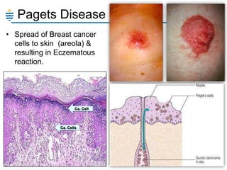 Pagets Disease
• Spread of Breast cancer
cells to skin (areola) &
resulting in Eczematous
reaction.

Ca. Cell

Ca. Cells

 