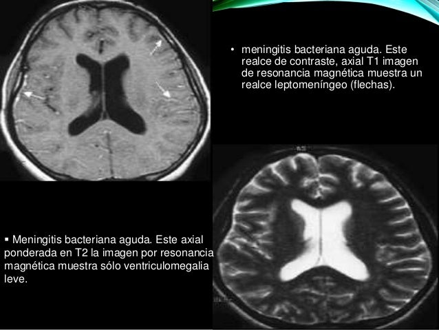 MENINGITIS BACTERIANA MENINGITIS BACTERIANA