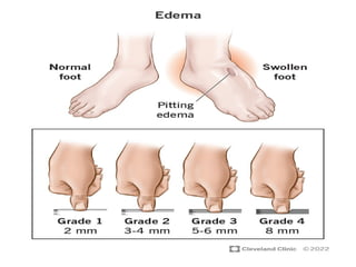 MBBS First year assessment of edema.pptx