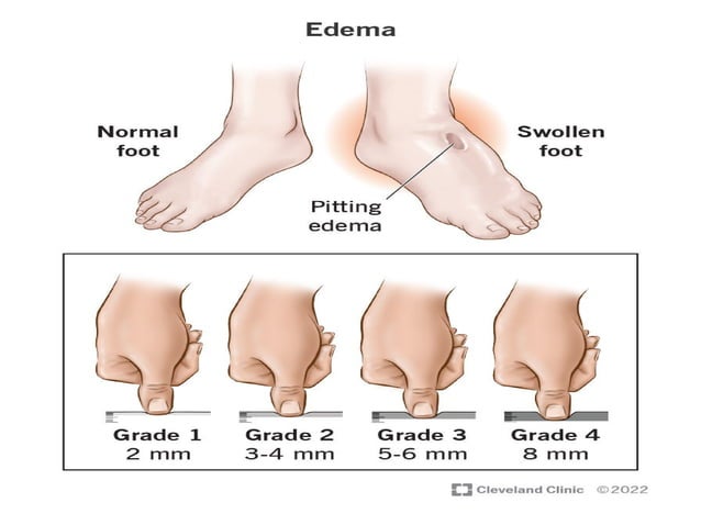 MBBS First year assessment of edema.pptx