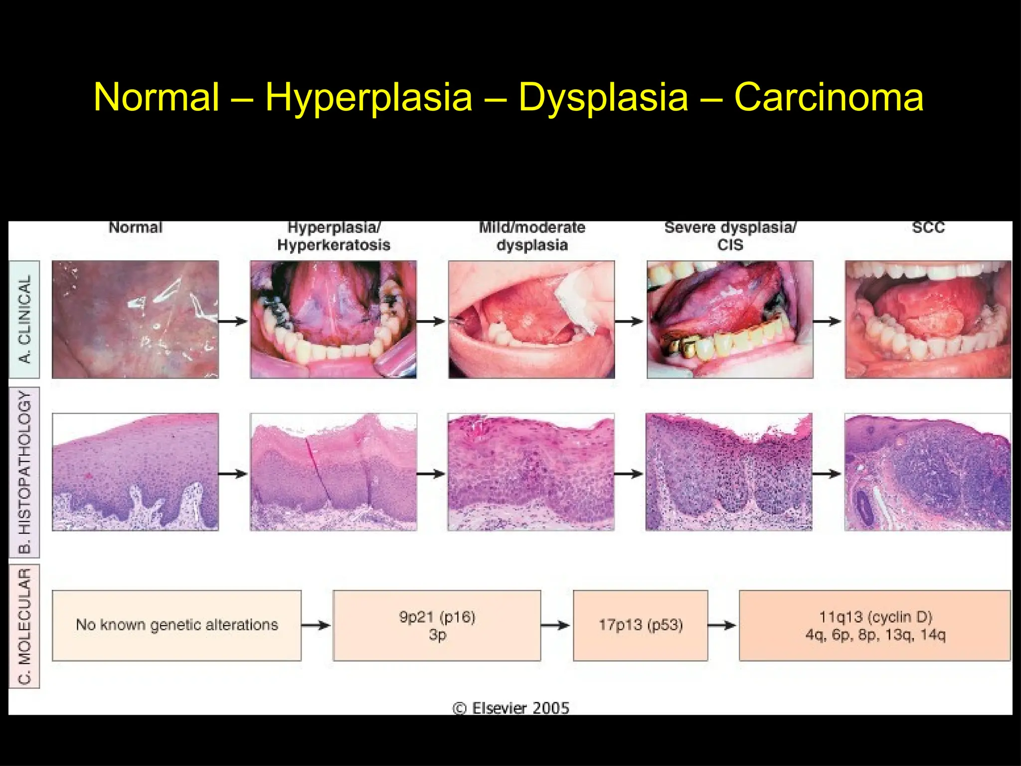 Normal – Hyperplasia – Dysplasia – Carcinoma
 