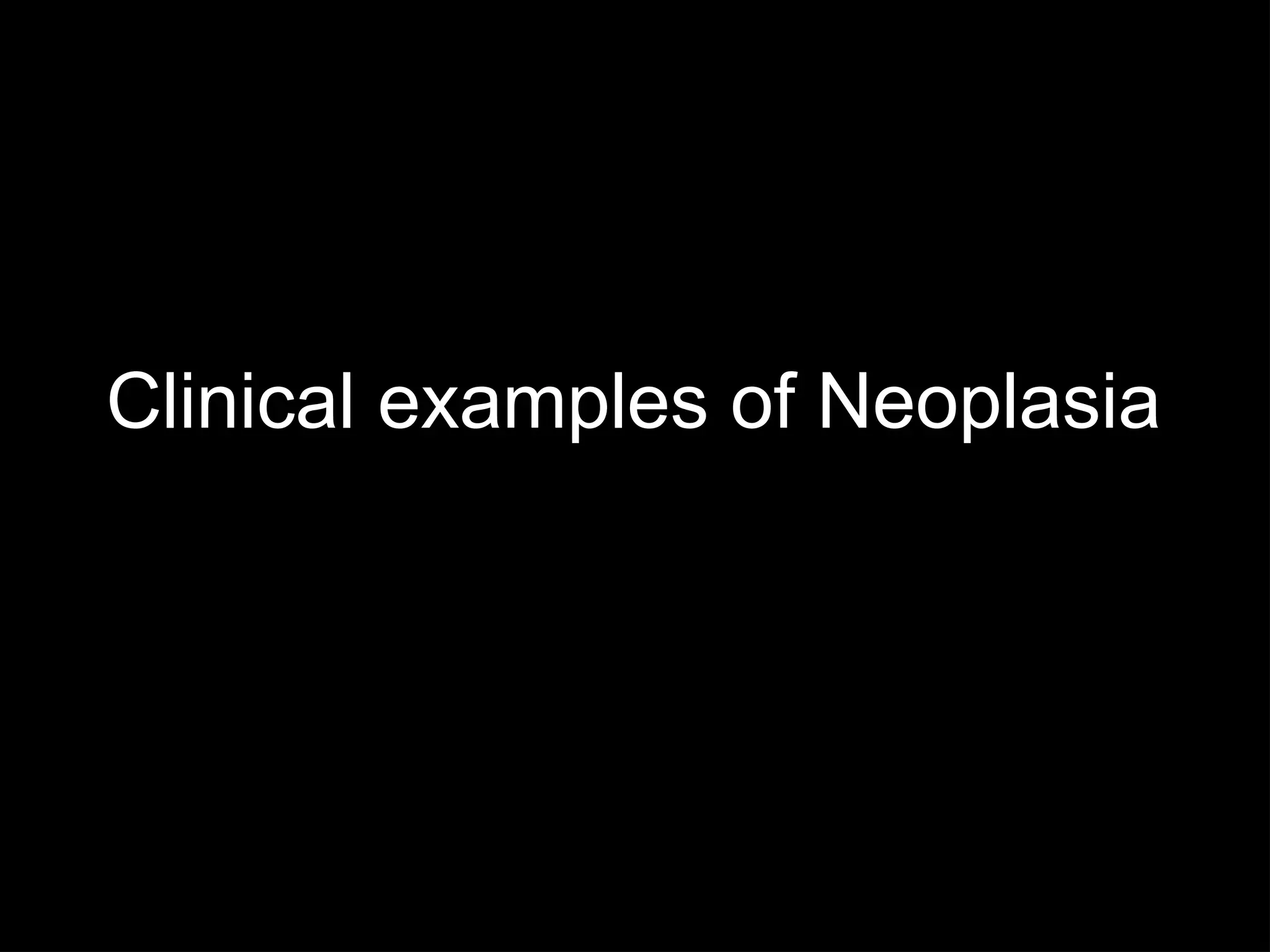 Clinical examples of Neoplasia
 