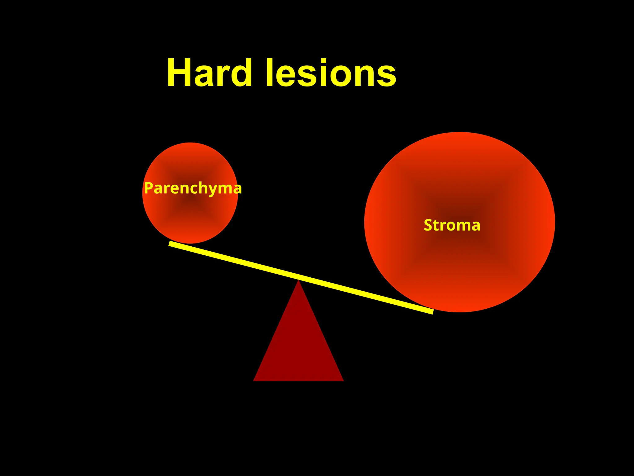 Hard lesions
Parenchyma
Stroma
 