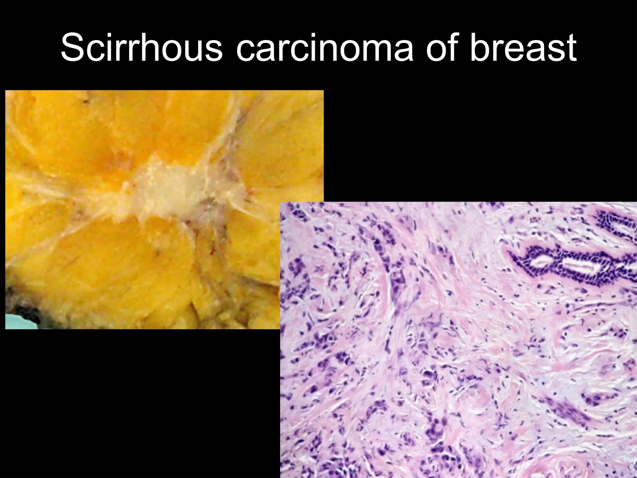 Scirrhous carcinoma of breast
 