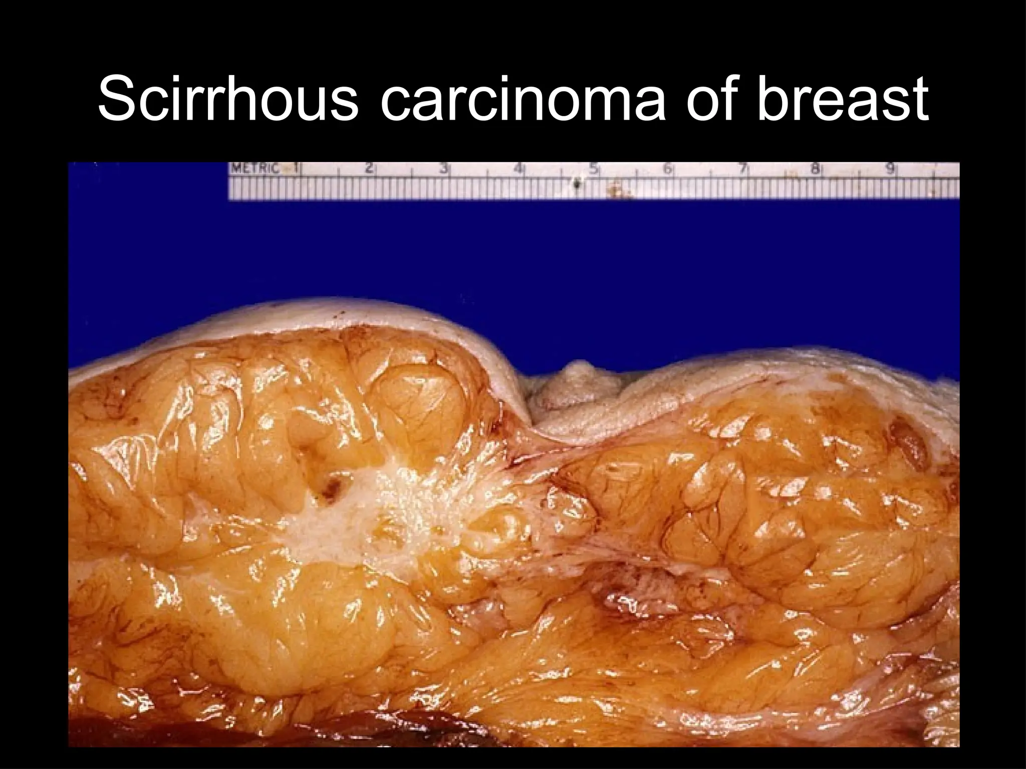 Scirrhous carcinoma of breast
 