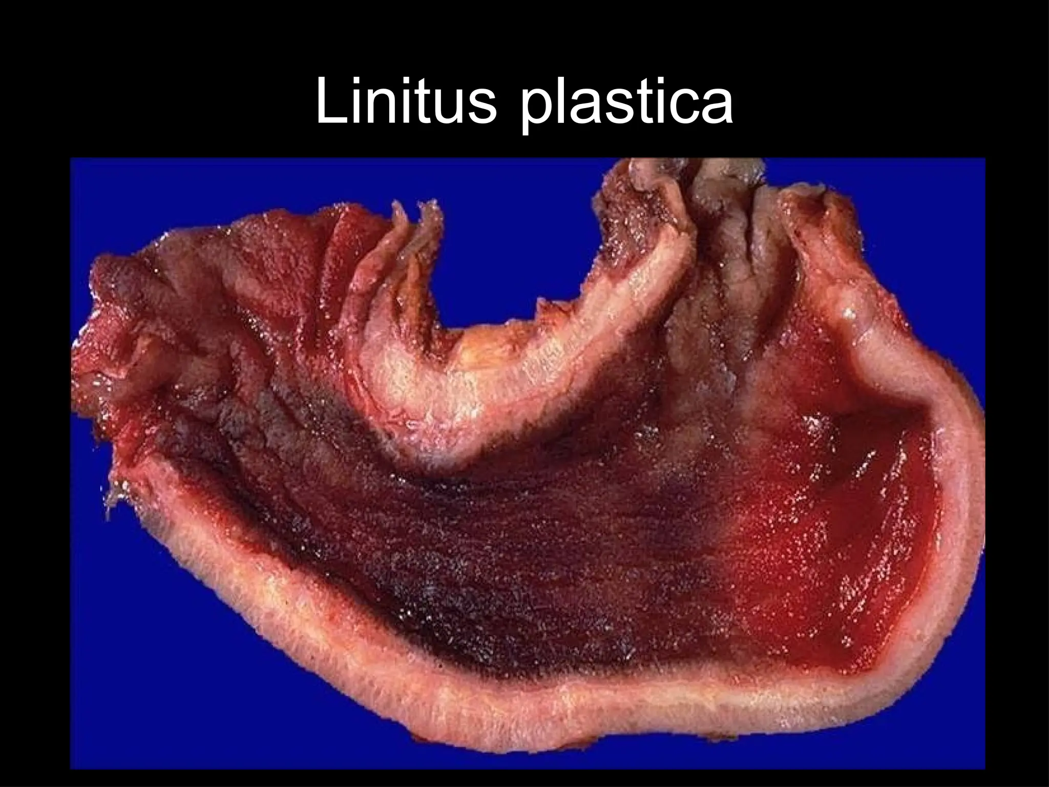 Linitus plastica
 