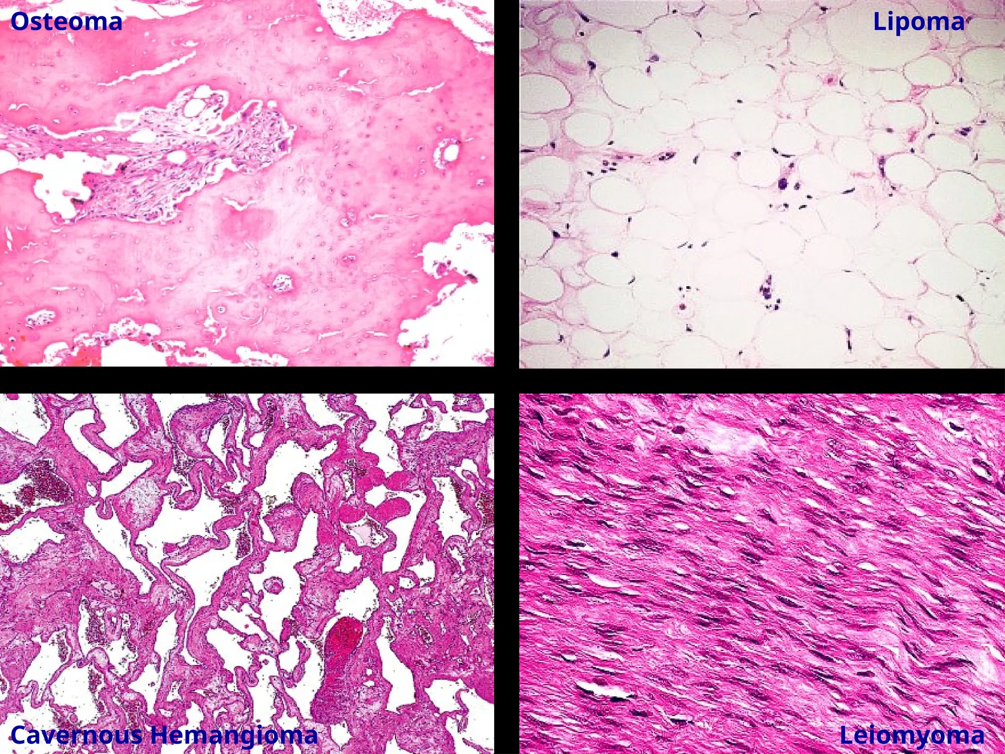 Osteoma Lipoma
Cavernous Hemangioma Leiomyoma
 