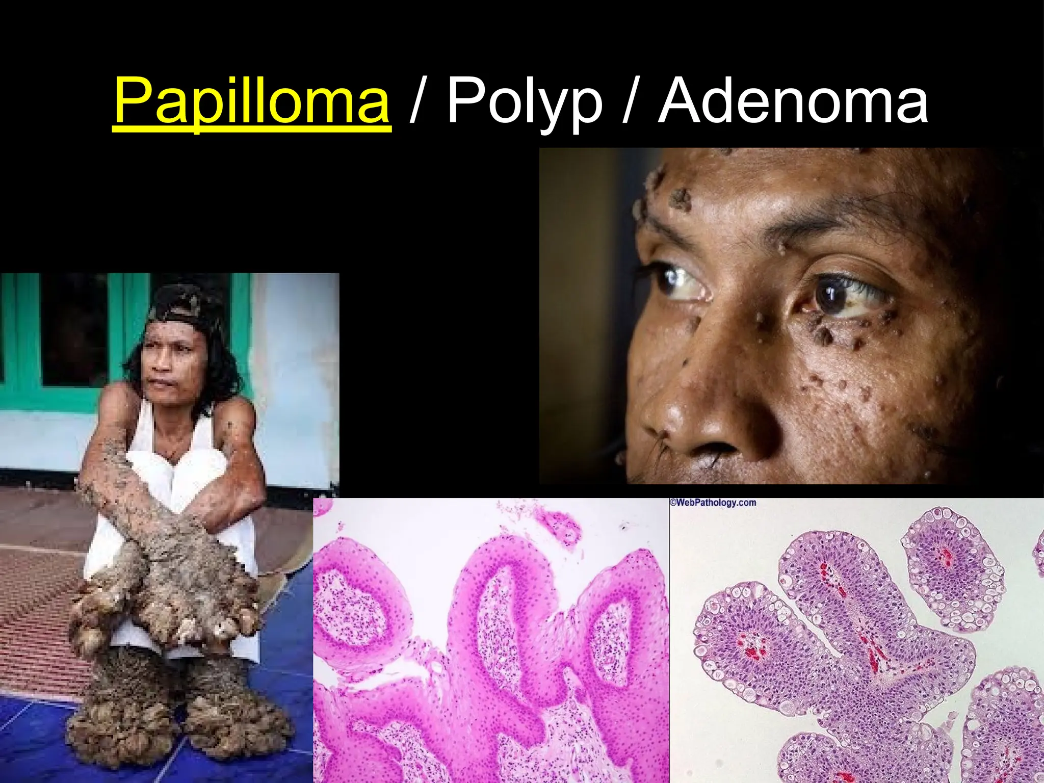 Papilloma / Polyp / Adenoma
 