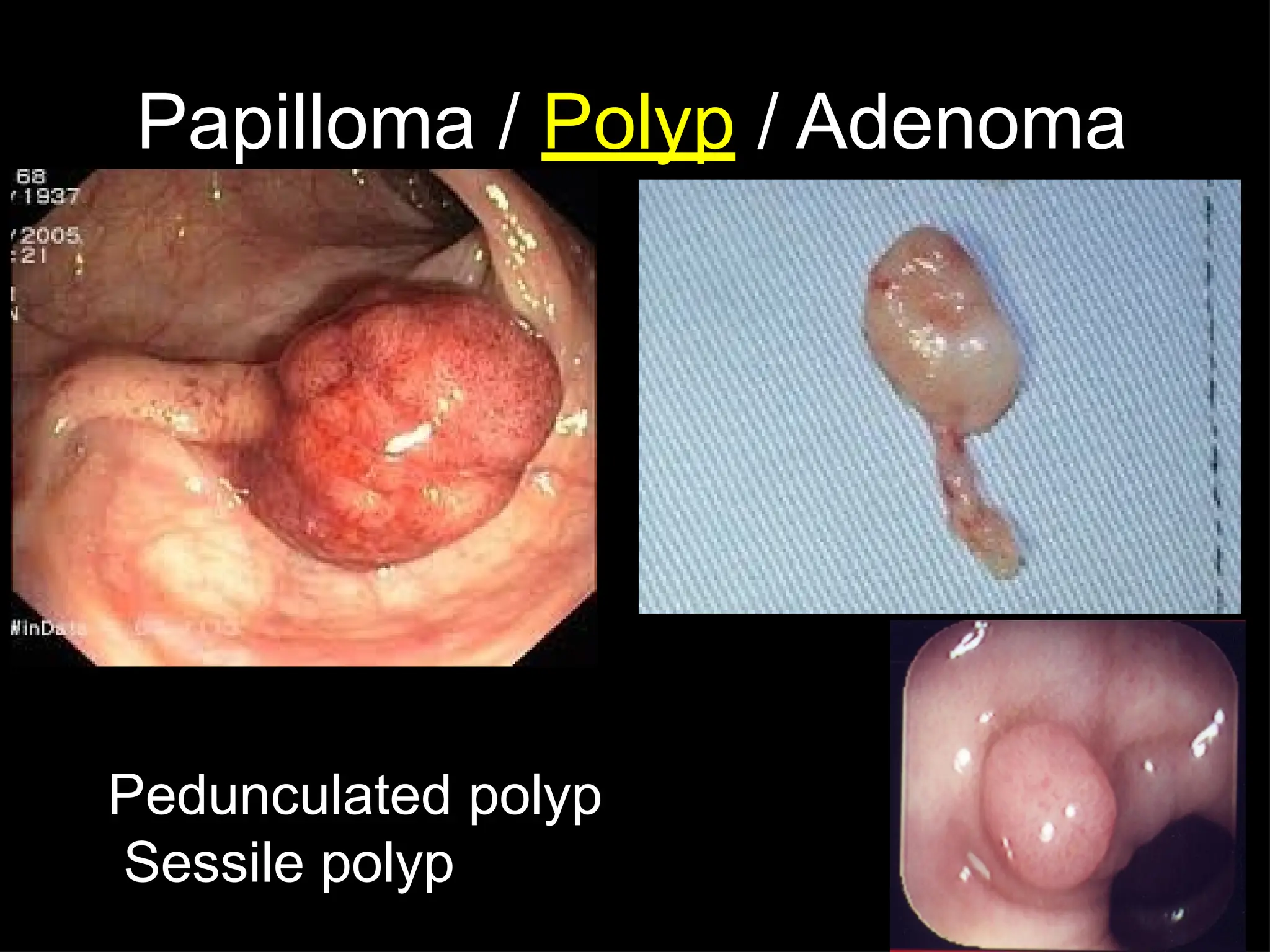 Papilloma / Polyp / Adenoma
Pedunculated polyp
Sessile polyp
 