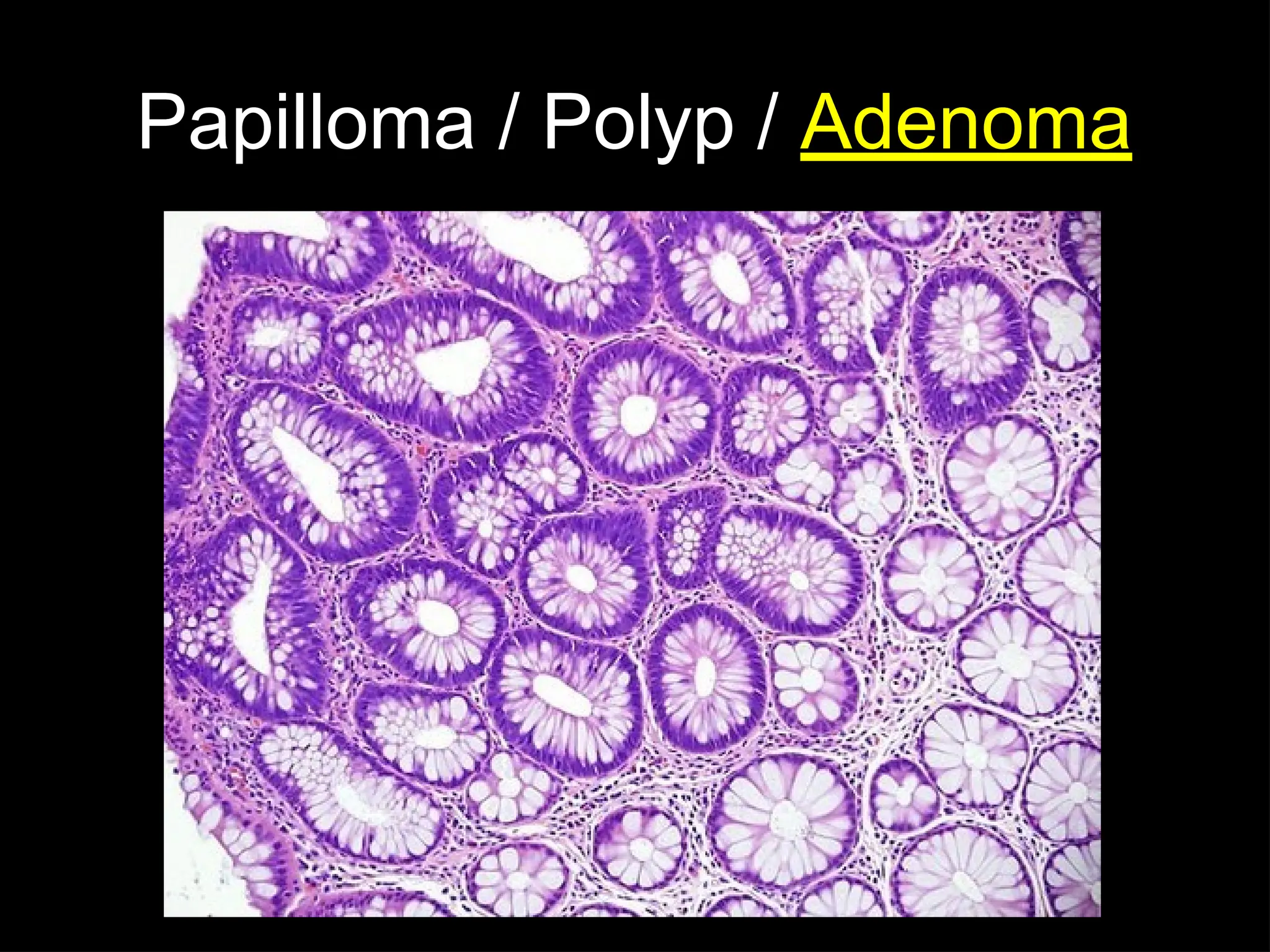 Papilloma / Polyp / Adenoma
 