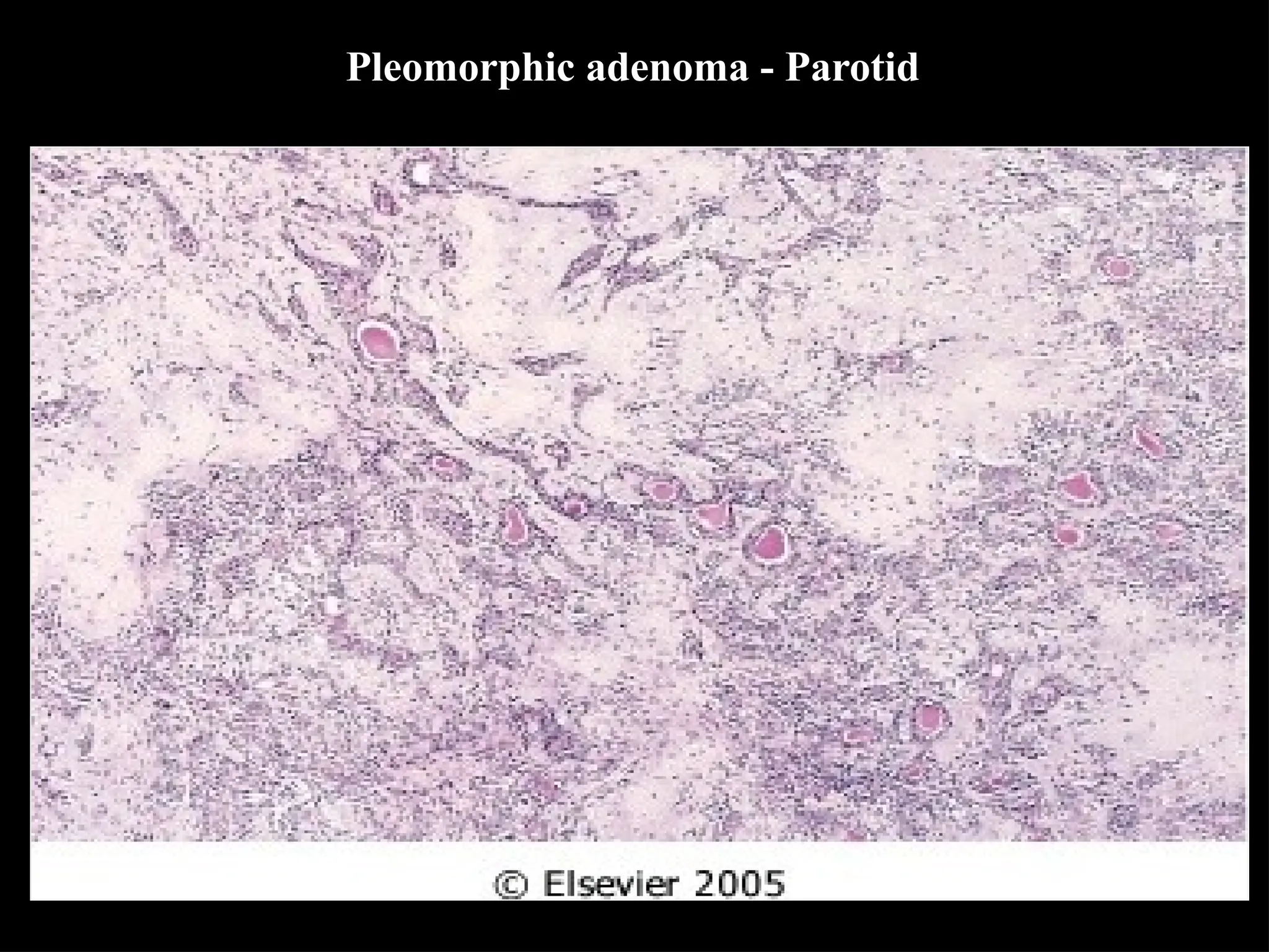 Pleomorphic adenoma - Parotid
 