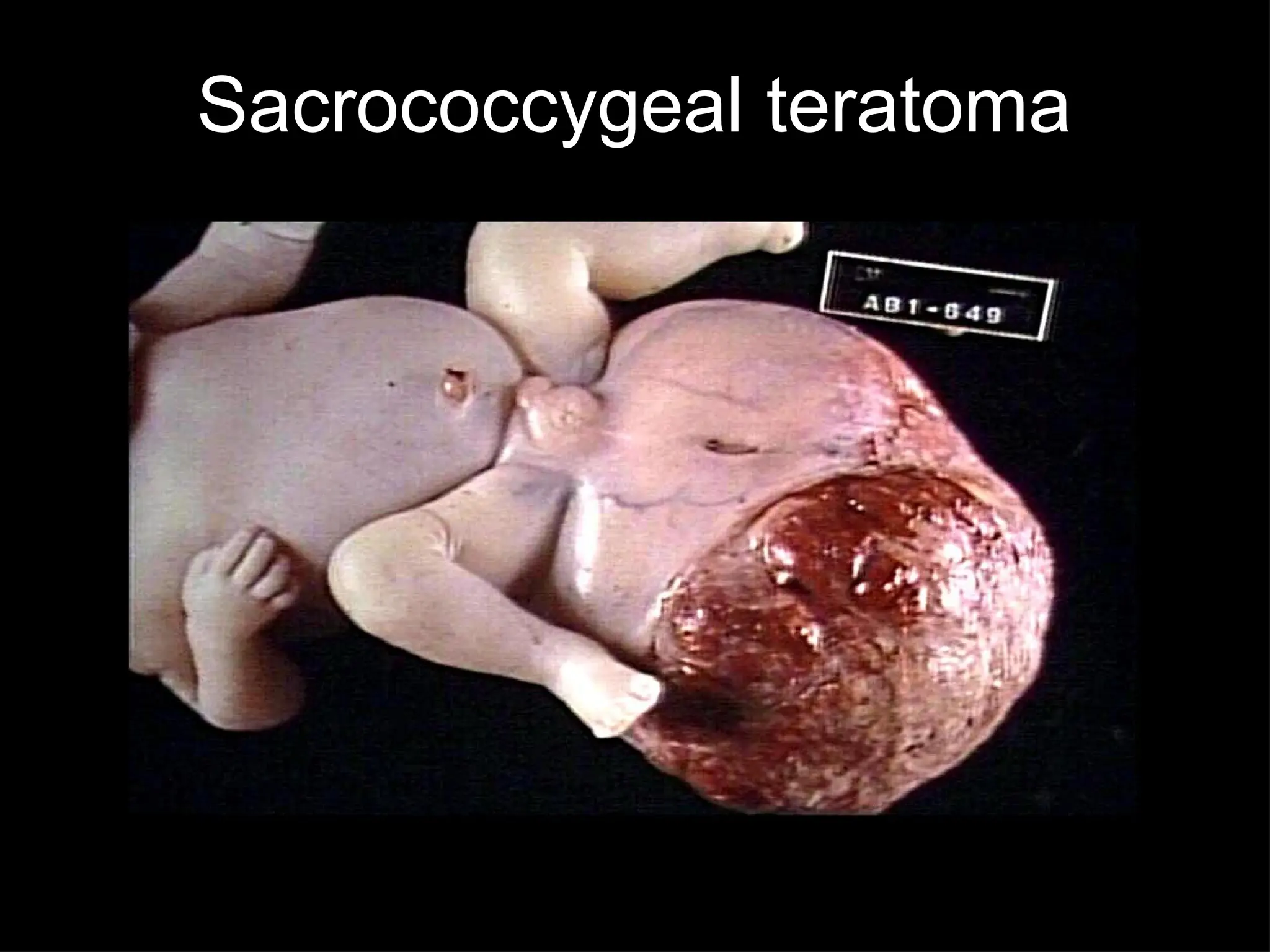 Sacrococcygeal teratoma
 