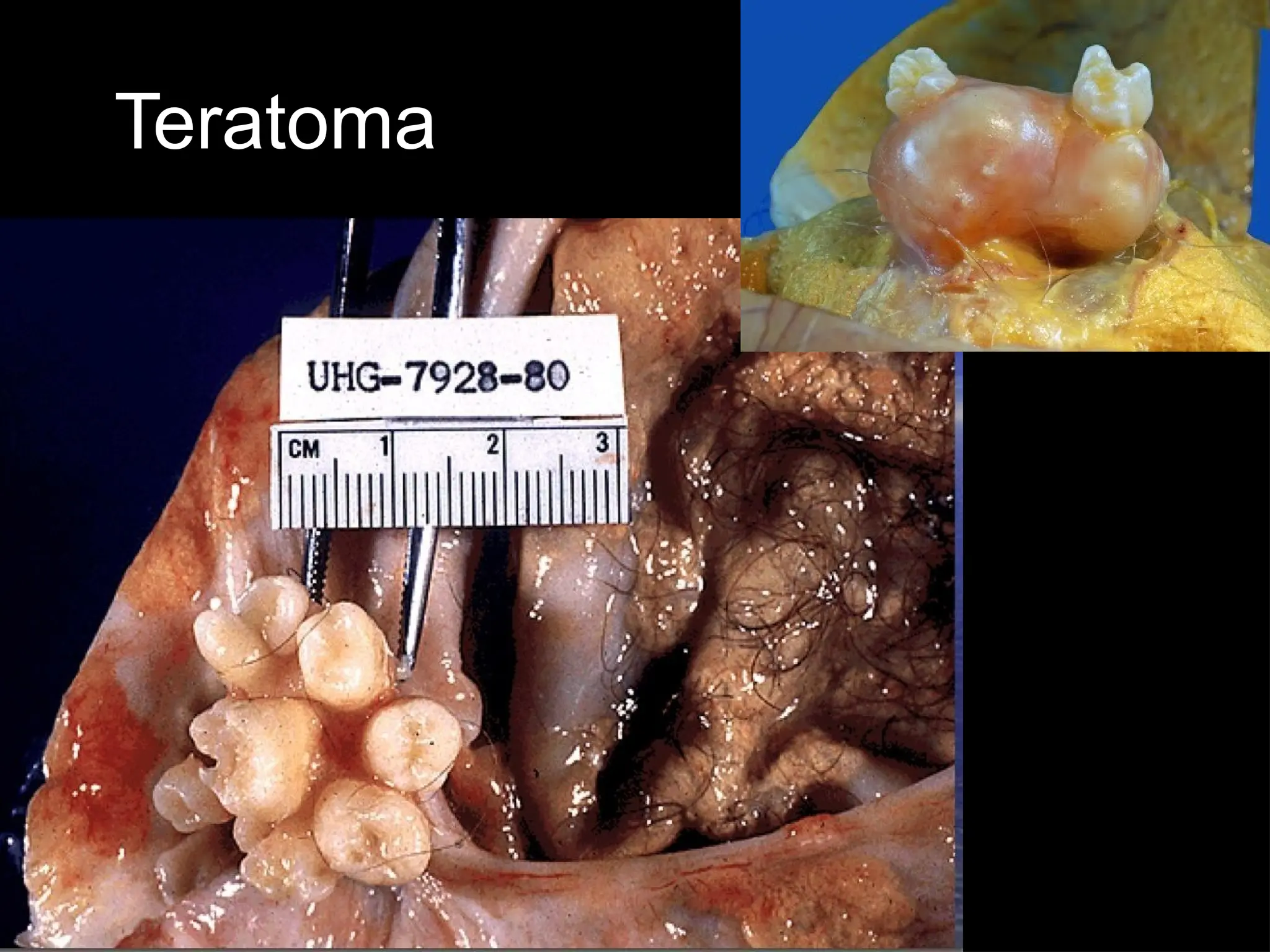 Teratoma
 