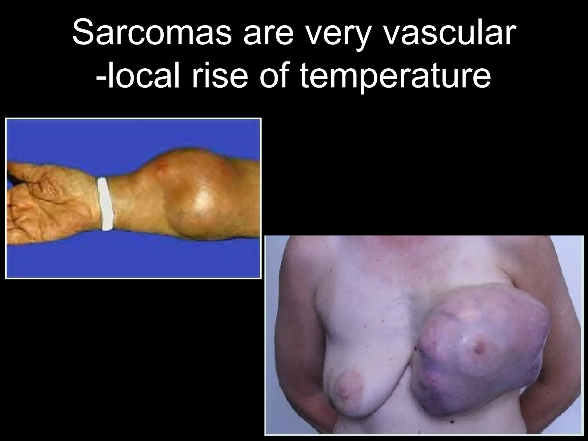 Sarcomas are very vascular
-local rise of temperature
 