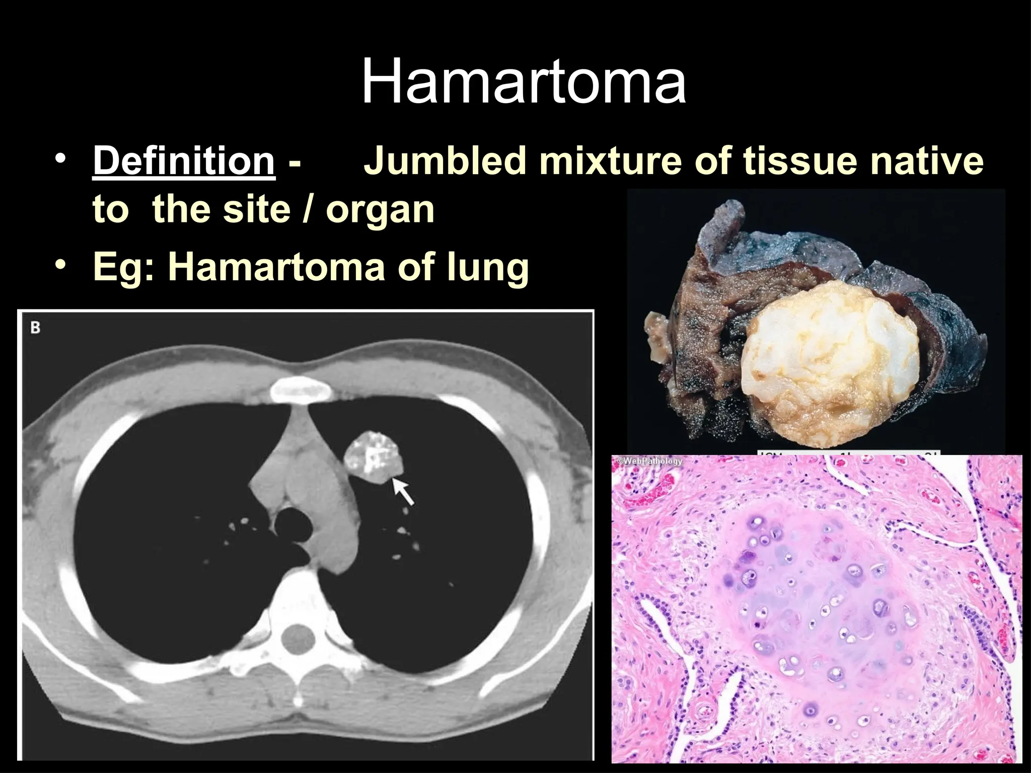 Hamartoma
• Definition - Jumbled mixture of tissue native
to the site / organ
• Eg: Hamartoma of lung
 