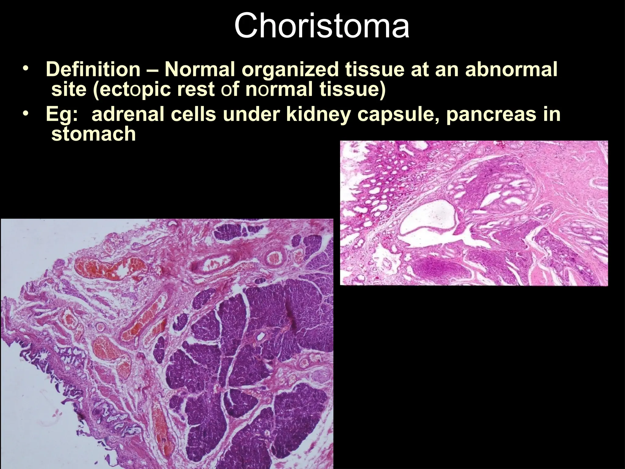 Choristoma
•
•
Definition – Normal organized tissue at an abnormal
site (ectopic rest of normal tissue)
Eg: adrenal cells under kidney capsule, pancreas in
stomach
 