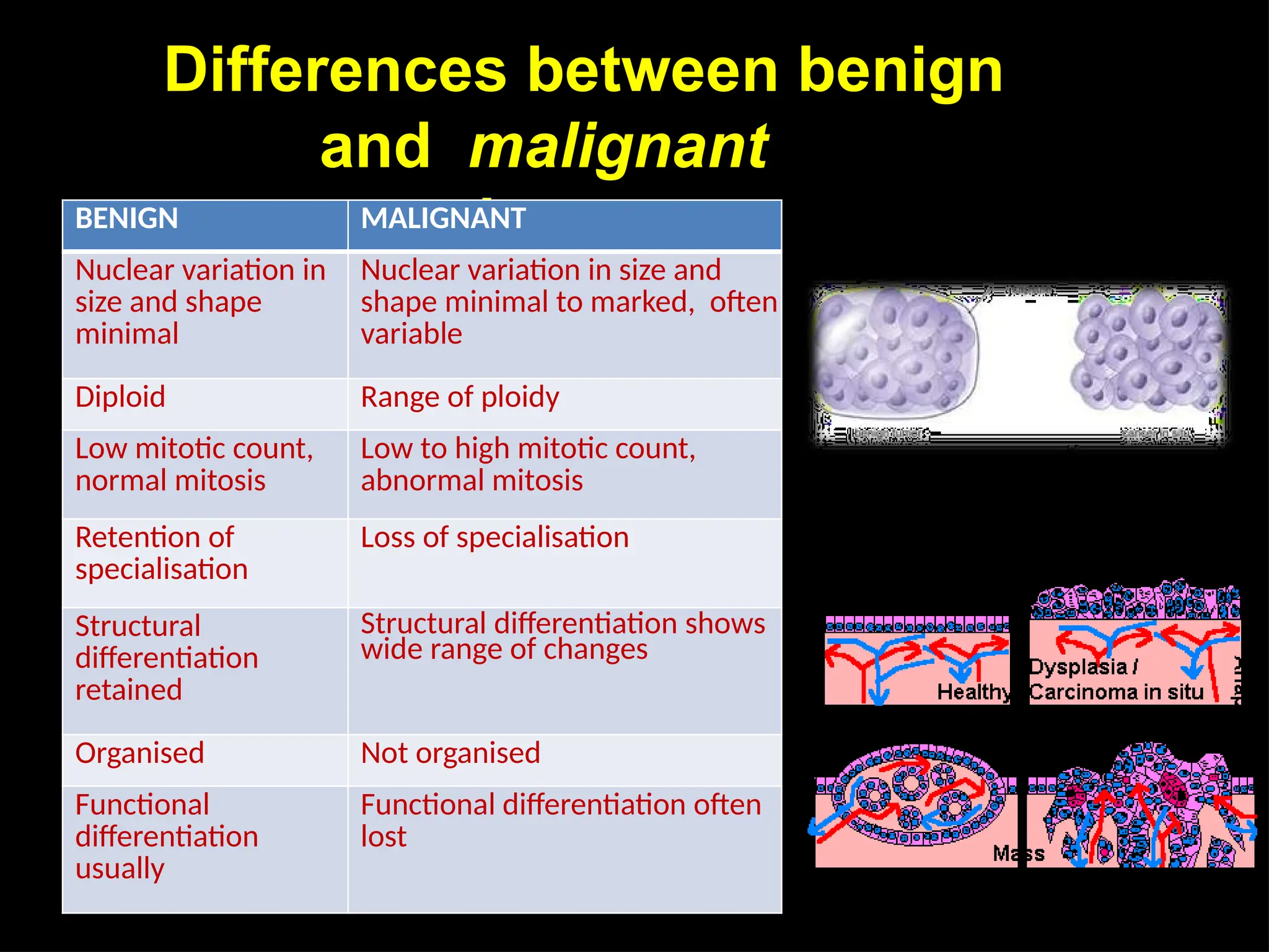 Differences between benign
and malignant
neoplasms
BENIGN MALIGNANT
Nuclear variation in
size and shape
minimal
Nuclear variation in size and
shape minimal to marked, often
variable
Diploid Range of ploidy
Low mitotic count,
normal mitosis
Low to high mitotic count,
abnormal mitosis
Retention of
specialisation
Loss of specialisation
Structural
differentiation
retained
Structural differentiation shows
wide range of changes
Organised Not organised
Functional
differentiation
usually
Functional differentiation often
lost
 