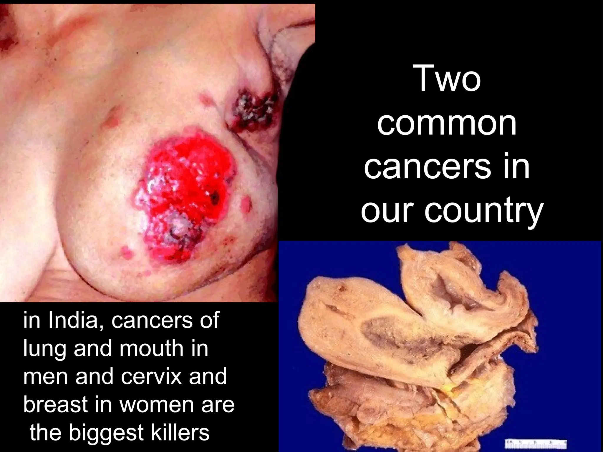 Two
common
cancers in
our country
in India, cancers of
lung and mouth in
men and cervix and
breast in women are
the biggest killers
 
