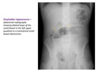 Step Ladder Radiography Medicine approach to plain abdominal XRAYS.pptx