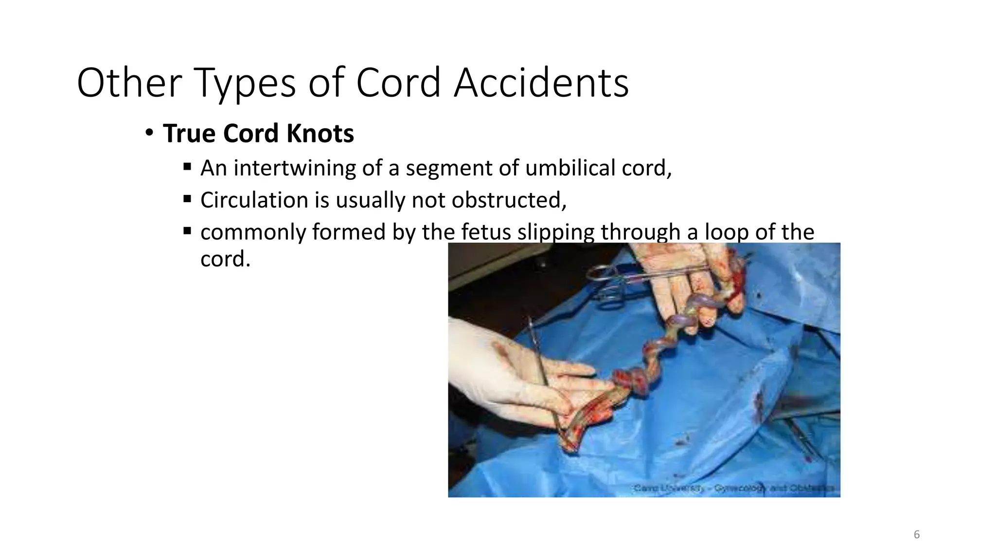 Other Types of Cord Accidents
• True Cord Knots
 An intertwining of a segment of umbilical cord,
 Circulation is usually not obstructed,
 commonly formed by the fetus slipping through a loop of the
cord.
6
KATTEY K.A (MBBS, MPH)
 