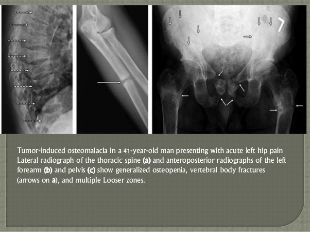 Imaging In Metabolic Bone Diseases