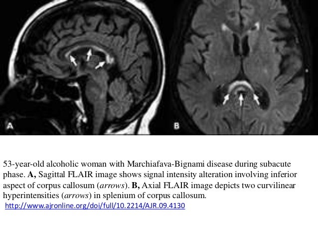 Marchiafava–Bignami disease (MBD)