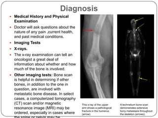 Metastatic Bone Disease & Role of Zoledronic Acid | PPTX