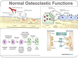 Metastatic Bone Disease & Role of Zoledronic Acid | PPTX