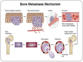 Metastatic Bone Disease & Role of Zoledronic Acid | PPTX