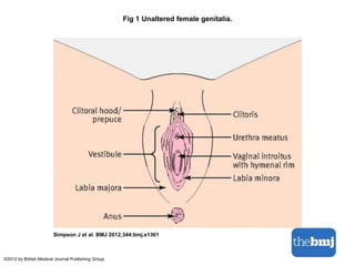 Fig 1 Unaltered female genitalia. 
Simpson J et al. BMJ 2012;344:bmj.e1361 
©2012 by British Medical Journal Publishing Group 
 