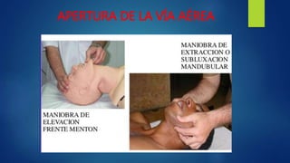 APERTURA DE LA VÍA AÉREA
 