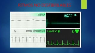 RITMOS NO DESFIBRILABLES
 