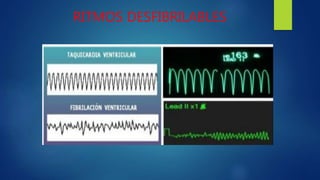 RITMOS DESFIBRILABLES
 