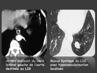 Artère naissant du bord
latéral gauche de l’aorte
destinée au LIG
Masse kystique du LIG
avec hypovascularisation
localisée
 