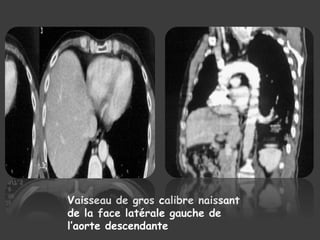 Vaisseau de gros calibre naissant
de la face latérale gauche de
l’aorte descendante
 