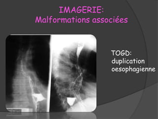IMAGERIE:
Malformations associées
TOGD:
duplication
oesophagienne
 