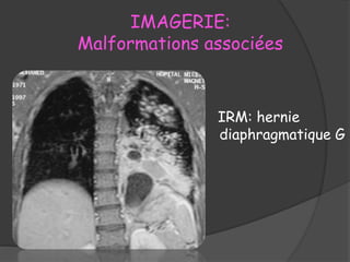 IMAGERIE:
Malformations associées
IRM: hernie
diaphragmatique G
 