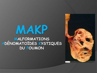 MAKP
MALFORMATIONS
ADÉNOMATOÏDES KYSTIQUES
DU POUMON
 
