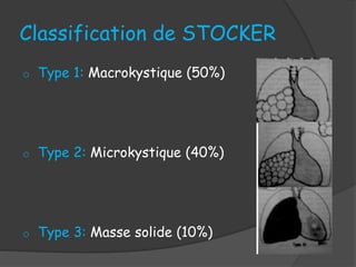 Classification de STOCKER
o Type 1: Macrokystique (50%)
o Type 2: Microkystique (40%)
o Type 3: Masse solide (10%)
 