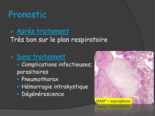 Pronostic
 Après traitement
Très bon sur le plan respiratoire
 Sans traitement
 Complications infectieuses;
parasitaires
 Pneumothorax
 Hémorragie intrakystique
 Dégénérescence
 