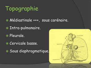 Topographie
 Médiastinale +++, sous carénaire.
 Intra-pulmonaire.
 Pleurale.
 Cervicale basse.
 Sous diaphragmatique.
 