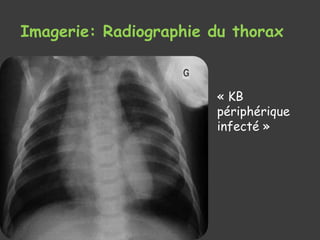 Imagerie: Radiographie du thorax
« KB
périphérique
infecté »
 