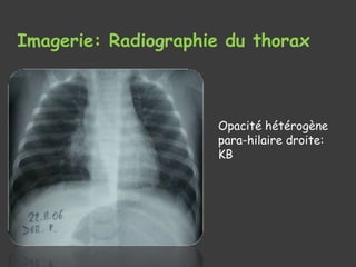 Imagerie: Radiographie du thorax
Opacité hétérogène
para-hilaire droite:
KB
 