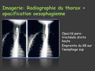 Imagerie: Radiographie du thorax +
opacification oesophagienne
Opacité para-
trachéale droite
haute
Empreinte du KB sur
l’œsophage sup
 