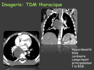 Imagerie: TDM thoracique
Hyperdensité
sous
carénaire
comprimant
principalemen
t la BSG
 