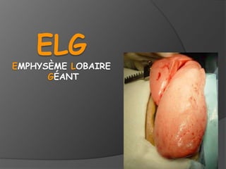 ELG
EMPHYSÈME LOBAIRE
GÉANT
 