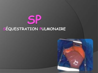 SP
SÉQUESTRATION PULMONAIRE
 